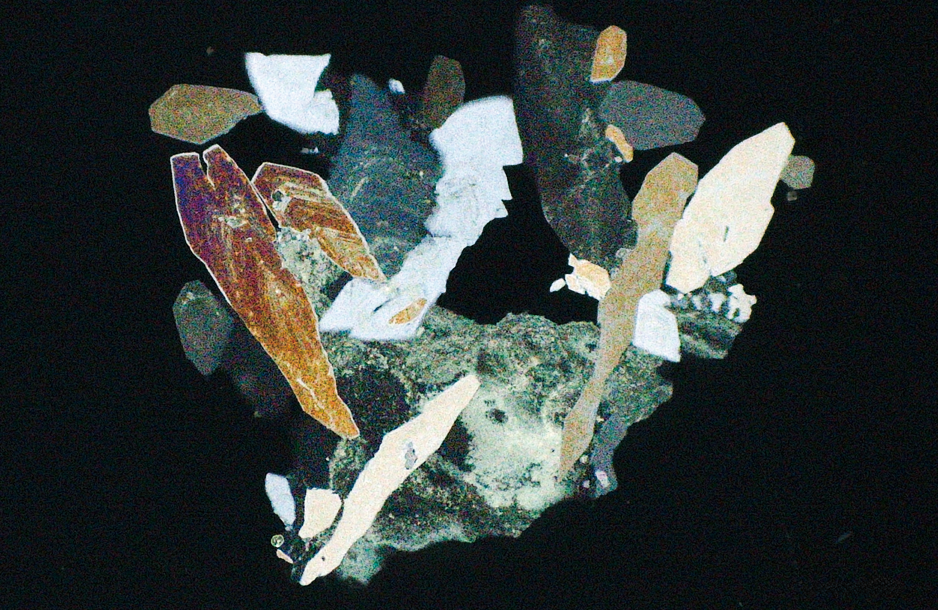Urinary stone (polarized light observation)